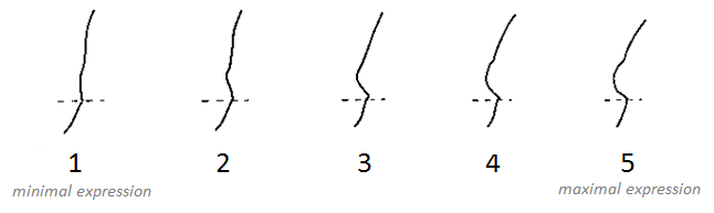 Supraorbital Ridge - Glabella