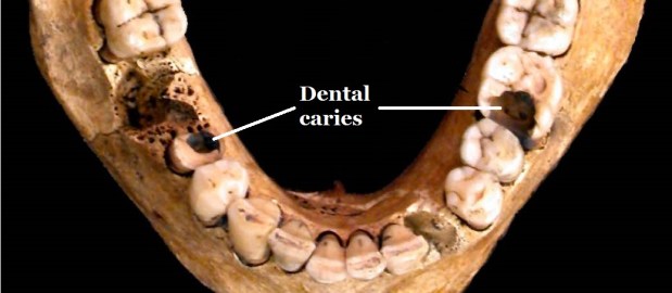 Quick Tips: Identifying Dental Diseases – Dental Caries.  